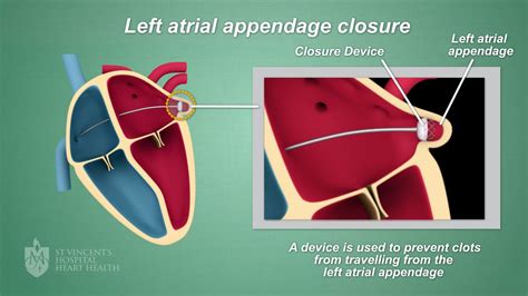 Left Atrial Appendage Closure Procedure