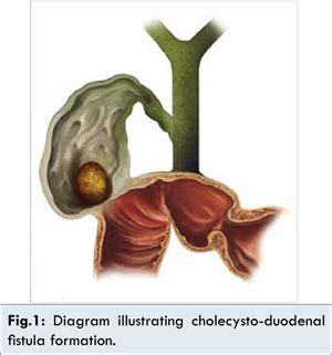 cholecystoduodenal fistula - Google Search (With images) | Syndrome, Gallstones