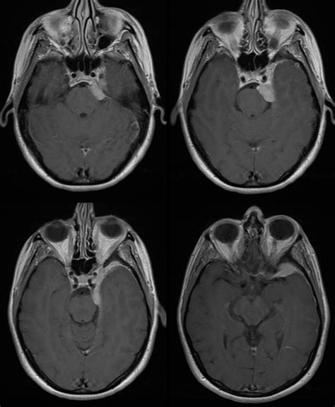 Archives Skull Base Meningioma Embolization MHT Access | neuroangio.org