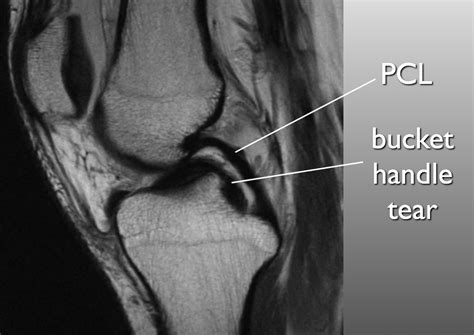 Double PCL sign - appears on sagittal MRI images of the knee when a ...