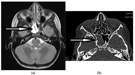 Sphenoid Sinus