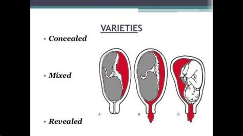 Baby And Placenta Diagram