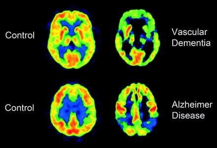 Vascular Dementia: Characteristics and Treatment - Exploring your mind