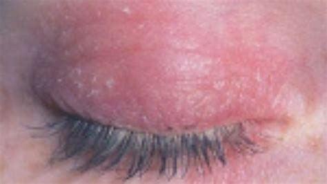 Contact Dermatitis Eyelid: Symptoms, Causes And Treatment - Health 24