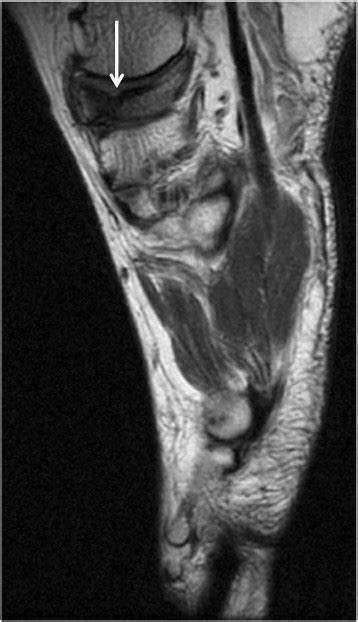 Mueller–Weiss syndrome: imaging and implications - Clinical Imaging