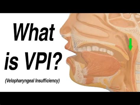 Velopharyngeal Insufficiency (VPI) Causing Hypernasal Speech and Nasal Regurgitation with ...