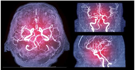 Cerebral Angiogram: Purpose, Preparation, Procedure, Aftercare & Risks