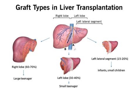 LIVING DONOR LIVER TRANSPLANT – LiverTransplantsIndia.in