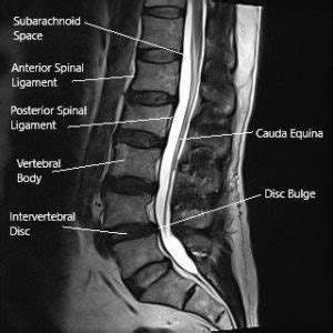 Prolapsed Intervertebral Disk (PIVD) | Complete Orthopedics | Multiple ...