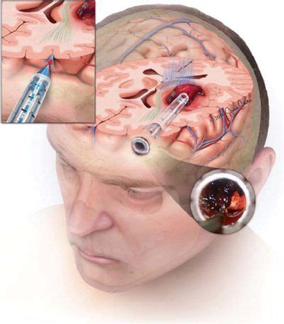 The Safety and Feasibility of Image-Guided BrainPath-Mediated Transsulcul Hematoma Evacuation: A ...