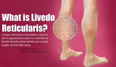 Livedo Reticularis | Livedo reticularis, Physician assistant programs, Dysautonomia