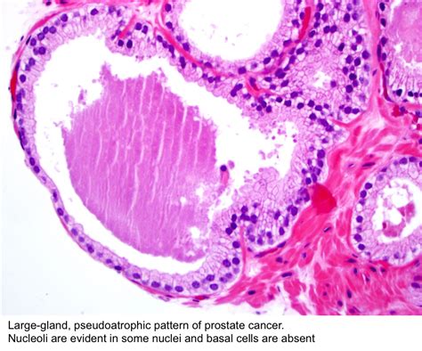 Pathology Outlines - Adenocarcinoma