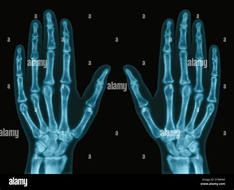 X ray normal hand hi-res stock photography and images - Alamy