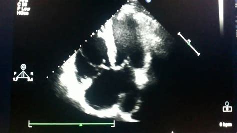 Echocardiogram - ostium primum atrial septal defect - YouTube