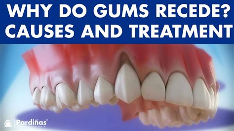 Gum recession - Treatment of gingival retraction © - YouTube