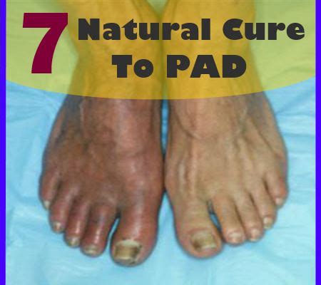 7 Natural Cure To PAD - How To Cure Peripheral Artery Disease | Find Home Remedy & Supplements