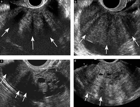 Ovarian Fibroma Ultrasound