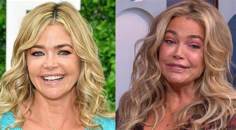 Denise Richards Before and After Plastic Surgery: boob, face