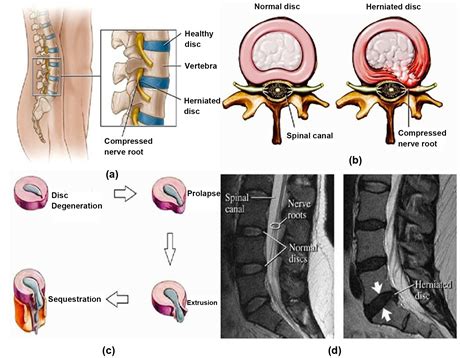 Percutaneous Endoscopic Lumbar Spine Surgery for Lumbar Disc Herniation and Lumbar Spine ...