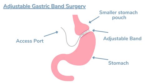 The Ultimate Guide to Gastric Banding Surgery: Everything You Need To Know – Bariatric Food Source