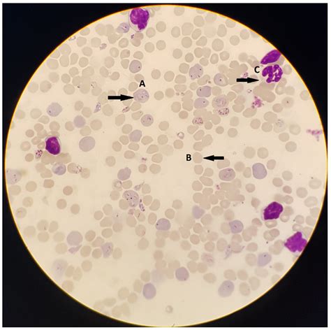 Malaria Parasite Under Microscope