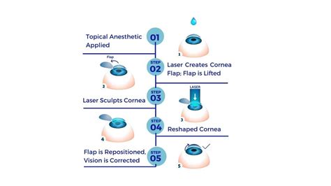 Lasik Eye Surgery Recovery Time