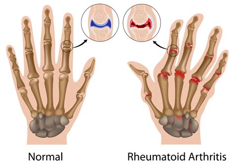 What Is Arthritis? It Could Be Gout, Rheumatoid Arthritis, or Osteoarthritis - University Health ...