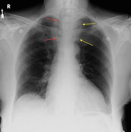 Widened superior mediastinum - Radiology at St. Vincent's University Hospital