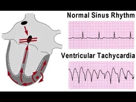 VENTRICULAR TACHYCARDIA (V Tach,VT) Causes,Symptoms & Management - YouTube