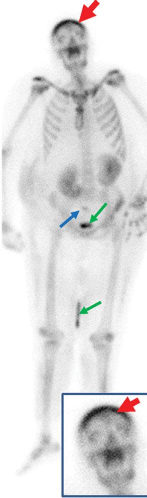 Looking at an unusual case of hypercalcemia Page 1