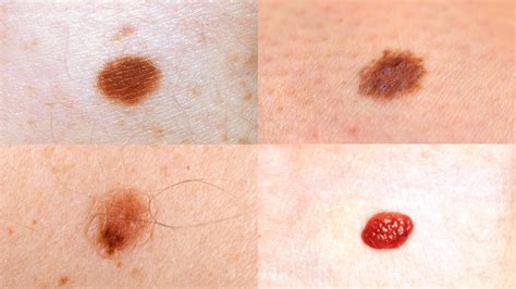 Early Stages Melanoma Skin Cancer Moles