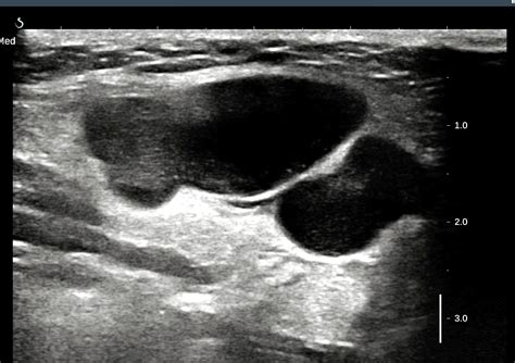 VIETNAMESE MEDIC ULTRASOUND: CASE 435: CERVICAL LYMPH NODES, Dr PHAN ...