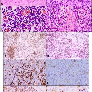 Excisional biopsy of an enlarged supraclavicular lymph node. (A)... | Download Scientific Diagram