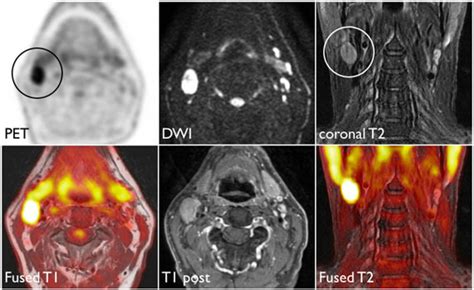 Mri Of Head And Neck