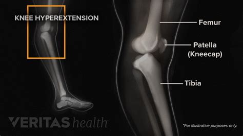 Diagnosing Knee Hyperextension