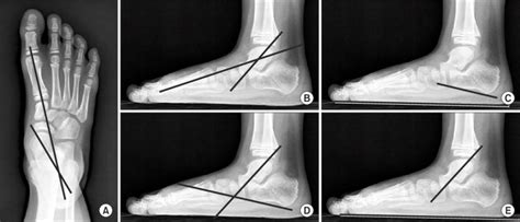 Radiographic indices in a flatfoot. (A) Anteroposterior view: talo-1st... | Download Scientific ...