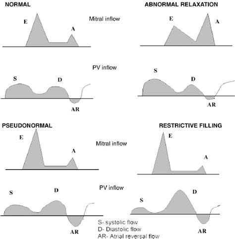 What Is Grade 1 Lv Diastolic Dysfunction | IUCN Water