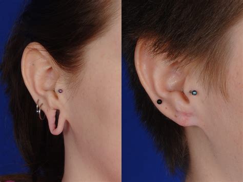 Before and After Earlobe Repair & Ear Surgery Photos