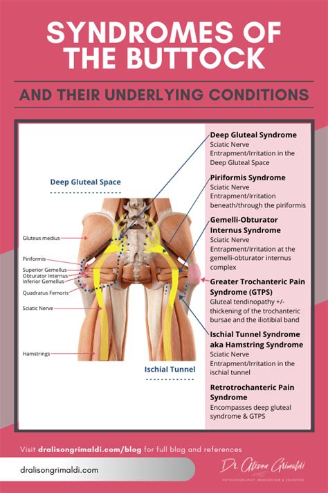 Piriformis Syndrome Pain Pattern