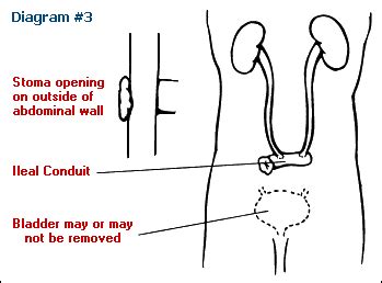 Urostomy: Ileal Conduit | Ostomy life, Ostomy, Stoma