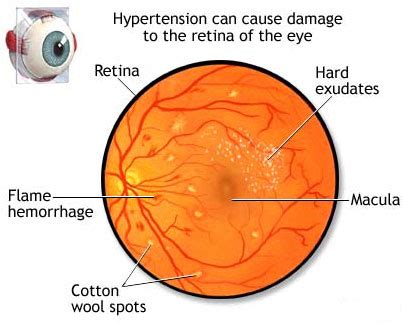 Stages Of Hypertensive Retinopathy