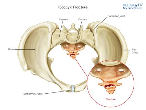 Coccyx Fracture | Rehab My Patient