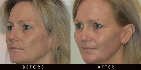 Laser Treatment On Face Before And After - your magazine lite