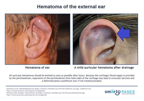 Hematoma of the external ear - Smarty PANCE