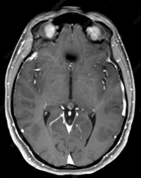 Large Developmental Venous Anomaly, MRI - Stock Image - C030/6374 - Science Photo Library