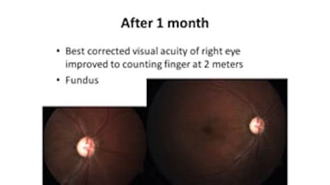 Optic Nerve Avulsion with Vitreous Hemorrhage and Pale Retina - ASRS ...