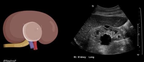 Parapelvic Cyst Ultrasound