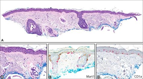 A, Histopathology of large-cell acanthoma, at low power, illustrates ...