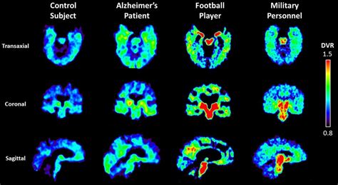 Molecular tracer, seen with PET scan, shows concentrations of abnormal proteins