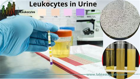 Leukocytes in Urine Test | Lab Tests Guide